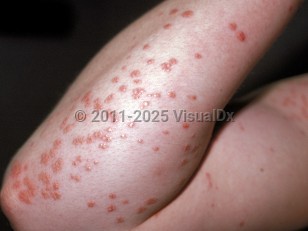 Clinical image of Eruptive xanthoma - imageId=100090. Click to open in gallery.  caption: 'Multiple smooth, yellowish, orange, and reddish papules on the arm.'
