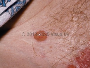 Clinical image of Bullous pemphigoid - imageId=108986. Click to open in gallery.  caption: 'A close-up of a tense bulla and a vesicle at the edge of a healing eroded plaque.'