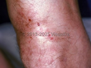 Dermatitis herpetiformis