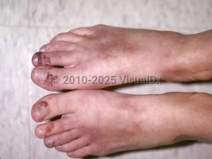 Clinical image of Granulomatosis with polyangiitis - imageId=153379. Click to open in gallery.  caption: 'Hemorrhagic bullae and vesicles on the distal toes and faint, maroon-colored patches on the dorsal feet.'