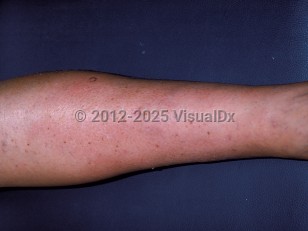 Clinical image of Calciphylaxis - imageId=153991. Click to open in gallery.  caption: 'A circumferential, erythematous plaque on the lower leg.'