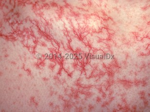 Clinical image of Generalized essential telangiectasia - imageId=1544705. Click to open in gallery.  caption: 'A close-up of telangiectatic patches.'