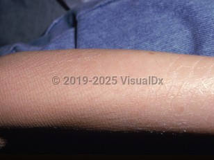Clinical image of Sjögren-Larsson syndrome - imageId=1611776. Click to open in gallery.  caption: 'Xerotic, linear, and ichthyotic plaques on the arm.'