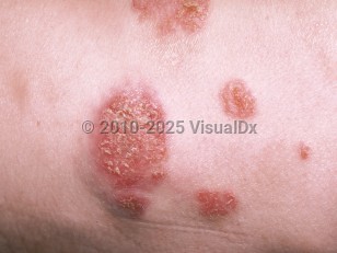 Clinical image of Cryptococcosis - imageId=166184. Click to open in gallery.  caption: 'A close-up of scaly and crusted papules and plaques some with a vegetating topography.'