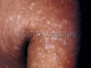 Pityriasis lichenoides chronica