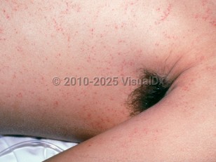 Clinical image of Fat emboli - imageId=1731889. Click to open in gallery.  caption: 'Myriads of pink and purpuric macules and papules on the trunk and arm, after a motor vehicle accident.'