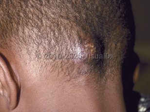 Clinical image of Kerion - imageId=180029. Click to open in gallery.  caption: 'A faintly violaceous nodule with superimposed pustules on the occipital scalp.'