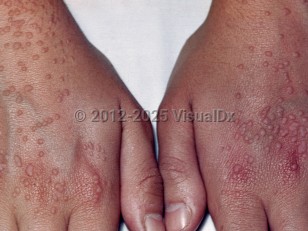 Clinical image of Flat wart - imageId=1881660. Click to open in gallery.  caption: 'Many discrete, pink and light brown, flat-topped, verrucous papules scattered over the dorsal hands. Note the linear arrays of warts indicative of autoinoculation.'