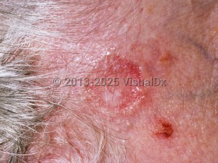 Clinical image of Nodular basal cell carcinoma - imageId=204149. Click to open in gallery.  caption: 'A reddish plaque with telangiectasias and a raised, shiny, rolled border at the anterior hairline.'