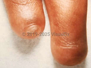 Clinical image of Congenital anonychia - imageId=2158435. Click to open in gallery.  caption: 'Absent fingernails.'