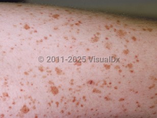 Clinical image of Capillaritis - imageId=221951. Click to open in gallery.  caption: 'Multiple tiny, cayenne pepper-type petechiae and golden-brown macules on the thigh.'