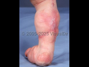 Clinical image of Lipoblastomatosis - imageId=2453048. Click to open in gallery.  caption: 'A diffusely enlarged leg and foot with overlying surgical scars and reddish plaques on the foot.'