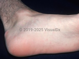 Clinical image of Streptobacillus moniliformis rat-bite fever - imageId=2529756. Click to open in gallery.  caption: 'Faint erythematous macules and thin papules on the foot.'