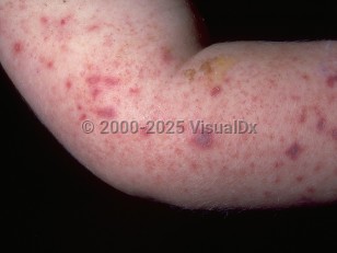 Clinical image of Acute meningococcemia - imageId=273564. Click to open in gallery.  caption: 'Widespread petechiae and purpura, some with deep gunmetal gray centers (signifying necrosis), on the arm.'