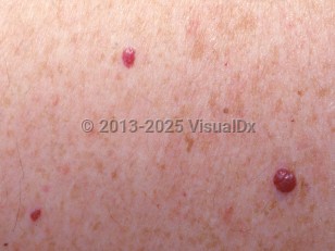 Clinical image of Cherry hemangioma - imageId=2832972. Click to open in gallery.  caption: 'A close-up of discrete red papules of varying sizes.'