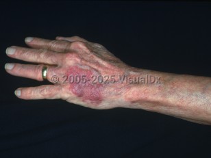 Clinical image of Solar purpura - imageId=2834784. Click to open in gallery.  caption: 'A purpuric patch on the dorsal hand. '