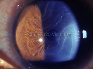 Ophthalmic Imaging image of Congenital glaucoma - imageId=2840357. Click to open in gallery.  caption: '<span>Haab's striae are swirly breaks in Descemet's membrane in congenital glaucoma.</span>'