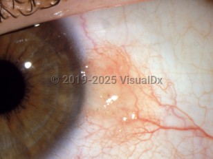 Ophthalmic Imaging image of Conjunctival nevus - imageId=2889663. Click to open in gallery.  caption: 'Tiny brown papule on the bulbar conjunctiva.'