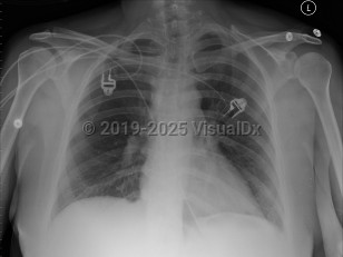 Imaging Studies image of Pulmonary embolism - imageId=2956045. Click to open in gallery.  caption: 'Frontal chest x-ray with no definite acute disease, most common finding on chest x-ray with pulmonary emboli.'