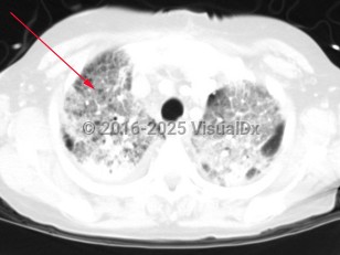Imaging Studies image of Haemophilus influenzae pneumonia - imageId=2997660. Click to open in gallery.  caption: 'Image from CT scan of the chest in lung windows demonstrating bilateral, diffuse ground glass opacities in the setting of chronic lung disease. '