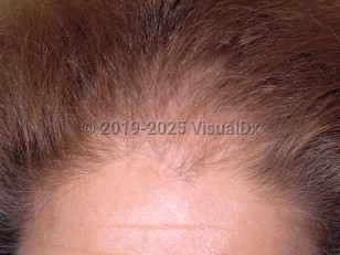 Female pattern alopecia