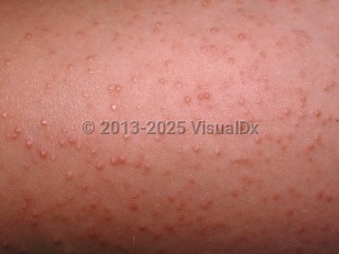 Clinical image of Keratosis pilaris - imageId=32898. Click to open in gallery.  caption: 'A close-up of follicularly-based, scaly, erythematous papules.'