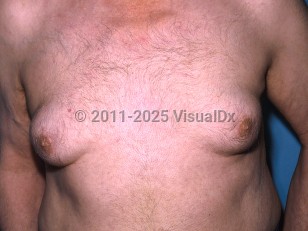 Clinical image of Gynecomastia - imageId=336348. Click to open in gallery.  caption: 'Enlarged breasts, secondary to a medication.'