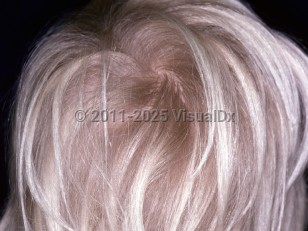 Clinical image of Loose anagen syndrome - imageId=3448064. Click to open in gallery.  caption: 'A young female child with light-colored hair and mild hair thinning.'