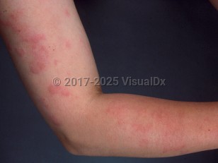 Urticaria
