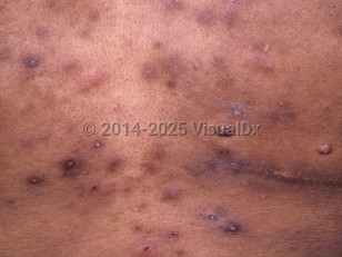 Clinical image of Eosinophilic folliculitis - imageId=388274. Click to open in gallery.  caption: 'A close-up of urticarial and excoriated, pink and brown papules on the chest of a patient with AIDS.'
