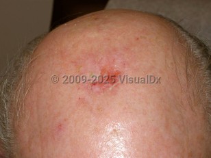 Clinical image of Erosive pustular dermatosis - imageId=4056502. Click to open in gallery.  caption: 'A crusted erosion with a surrounding faint pink scar on the central scalp. Note also the single pustule on the anterior scalp.'