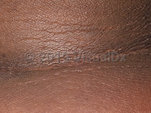Acanthosis nigricans