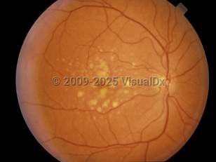 Ophthalmic Imaging image of Age-related macular degeneration - imageId=4378880. Click to open in gallery. 
