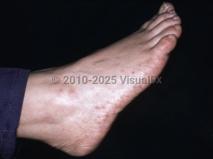 Clinical image of Atrial myxoma - imageId=4766940. Click to open in gallery.  caption: 'Violaceous discoloration of the toes and purpuric papules on the foot.'