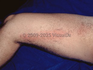 Cellulitis