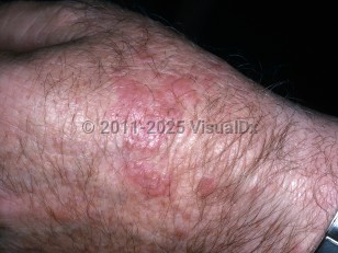 Clinical image of Actinic granuloma - imageId=5687617. Click to open in gallery.  caption: 'Smooth pink papules and plaques on the dorsal hand.'