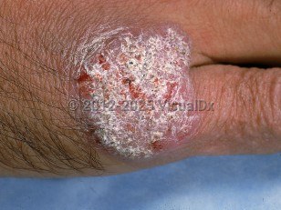 Clinical image of Chromoblastomycosis - imageId=573021. Click to open in gallery.  caption: 'A thickly scaly and crusted pink plaque on the dorsal hand.'