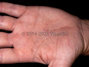 Hand eczema