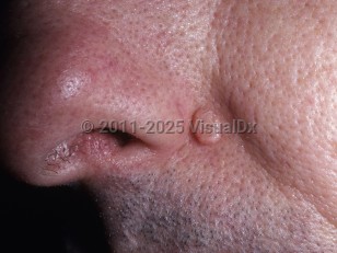Clinical image of Trichoepithelioma - imageId=5928829. Click to open in gallery.  caption: 'A large, smooth, shiny papule at the nasal alar crease.'