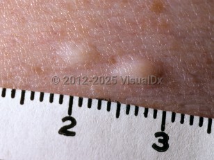 Clinical image of Multiple endocrine neoplasia type 1 - imageId=6105791. Click to open in gallery.  caption: 'A close-up of two yellowish-white papules (collagenomas).'