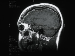 Subdural empyema