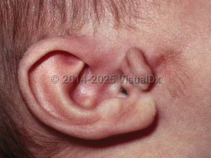 Clinical image of Goldenhar syndrome - imageId=6314460. Click to open in gallery.  caption: 'A malformed tragus and preauricular skin tags.'