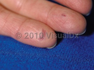 Clinical image of Limited cutaneous systemic sclerosis - imageId=64099. Click to open in gallery.  caption: 'Violaceous, telangiectatic macules on the fingers.'