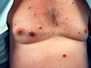 Clinical image of Glomeruloid hemangioma - imageId=6555944. Click to open in gallery.  caption: 'Smooth red papules and nodules scattered on the anterior trunk.'