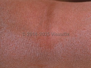 Clinical image of X-linked ichthyosis - imageId=658185. Click to open in gallery.  caption: 'Diffuse fine-scaling around the popliteal fossa.'