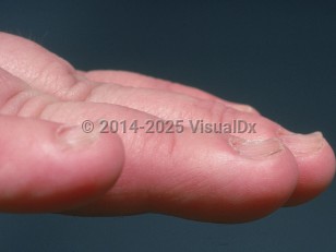 Clinical image of Koilonychia - imageId=659299. Click to open in gallery.  caption: 'Concave fingernails with central depressions and everted edges. Onychorrhexis is also present.'