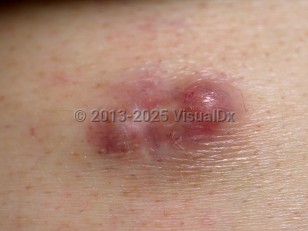 Clinical image of Proliferating pilar tumor - imageId=6668352. Click to open in gallery.  caption: 'A close-up of a smooth, reddish-pink and yellowish plaque with a dumbbell appearance.'