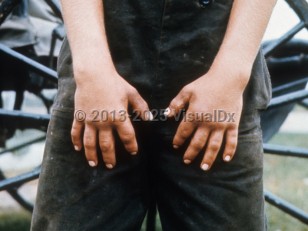 Clinical image of Weill-Marchesani syndrome - imageId=6773916. Click to open in gallery.  caption: '"Stubby," short fingers.'