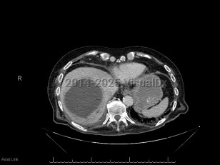 Imaging Studies image of Pyogenic liver abscess - imageId=6828400. Click to open in gallery.  caption: '<span>Axial CT image demonstrates a  large thick-walled fluid collection at the hepatic dome with mildly  enhancing peripheral rim, consistent with liver abscess.</span>'