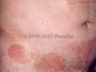 Clinical image of Cutaneous T-cell lymphoma - imageId=70243. Click to open in gallery.  caption: 'Patch stage mycosis fungoides, showing thin scaly erythematous and brown plaques on the lower abdomen.'